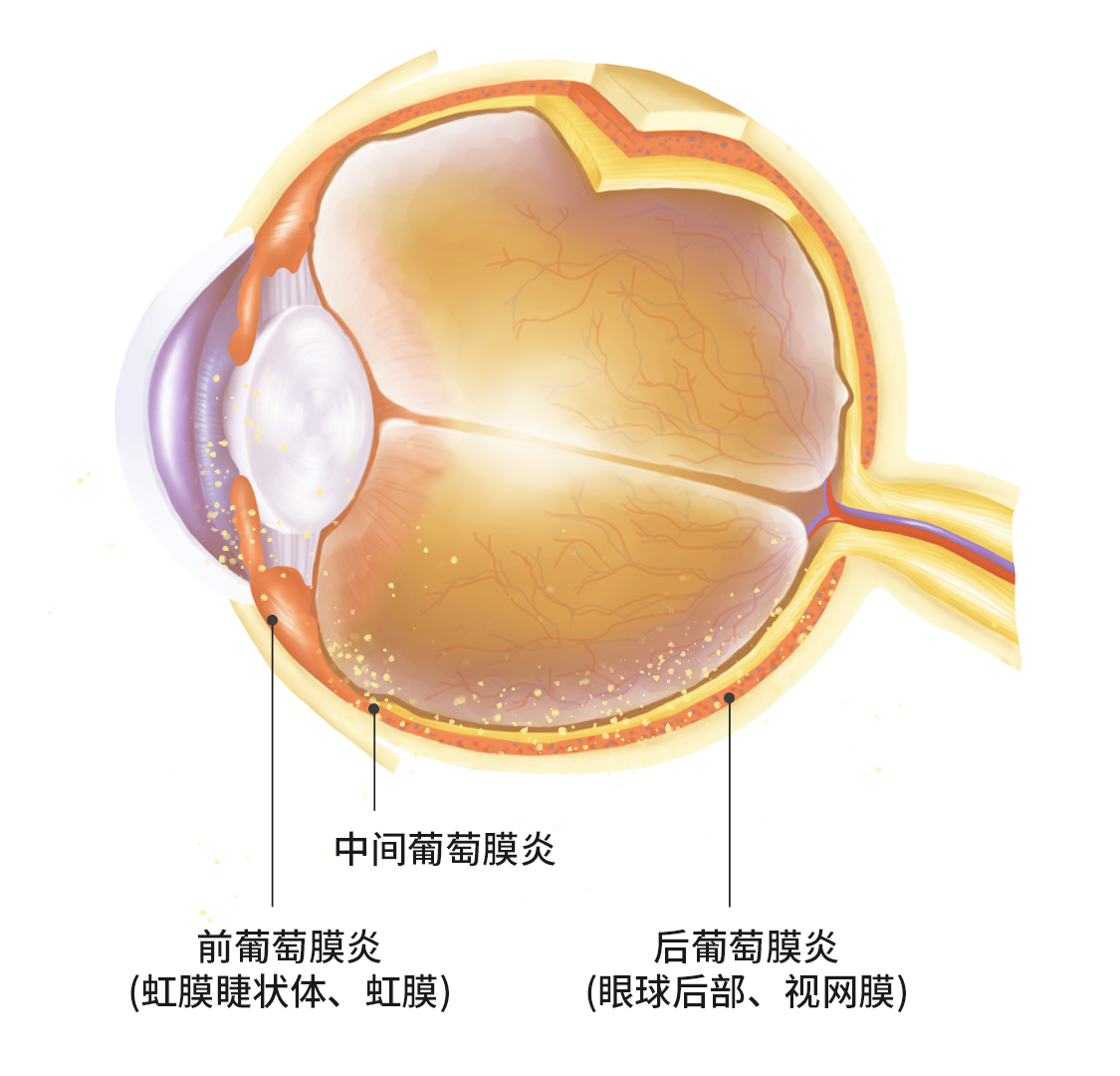 葡萄膜炎